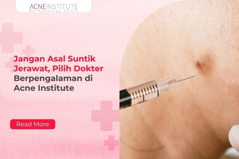 Jangan Asal Suntik Jerawat, Pilih Dokter Berpengalaman di Acne Institute