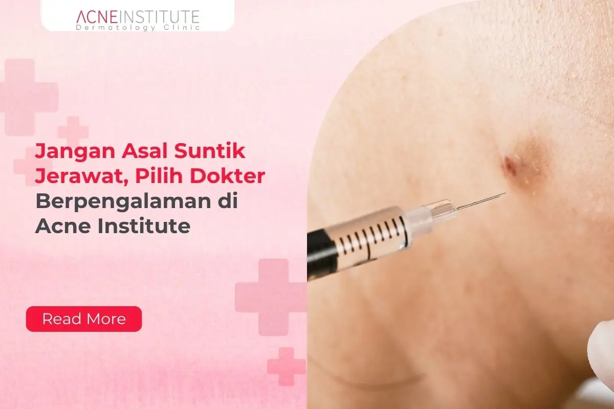 Jangan Asal Suntik Jerawat, Pilih Dokter Berpengalaman di Acne Institute