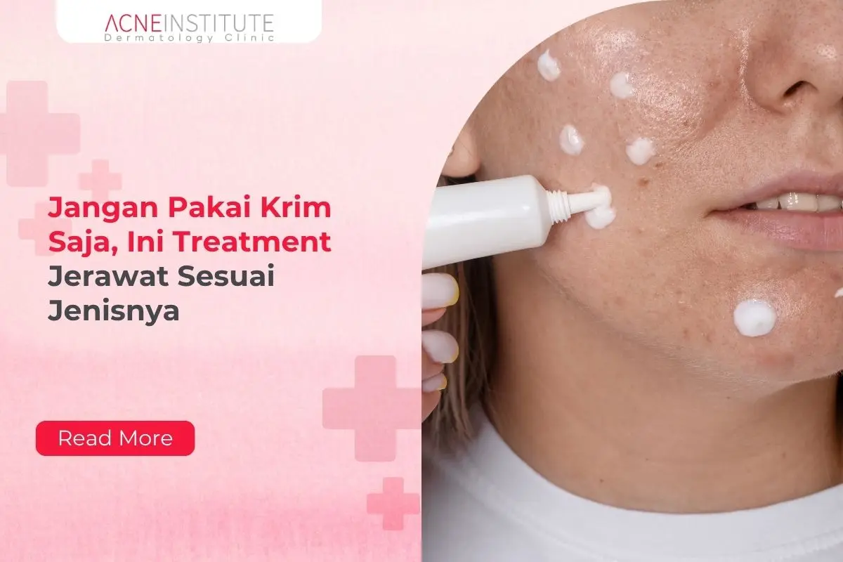Jangan Pakai Krim Saja, Ini Treatment Jerawat Sesuai Jenisnya