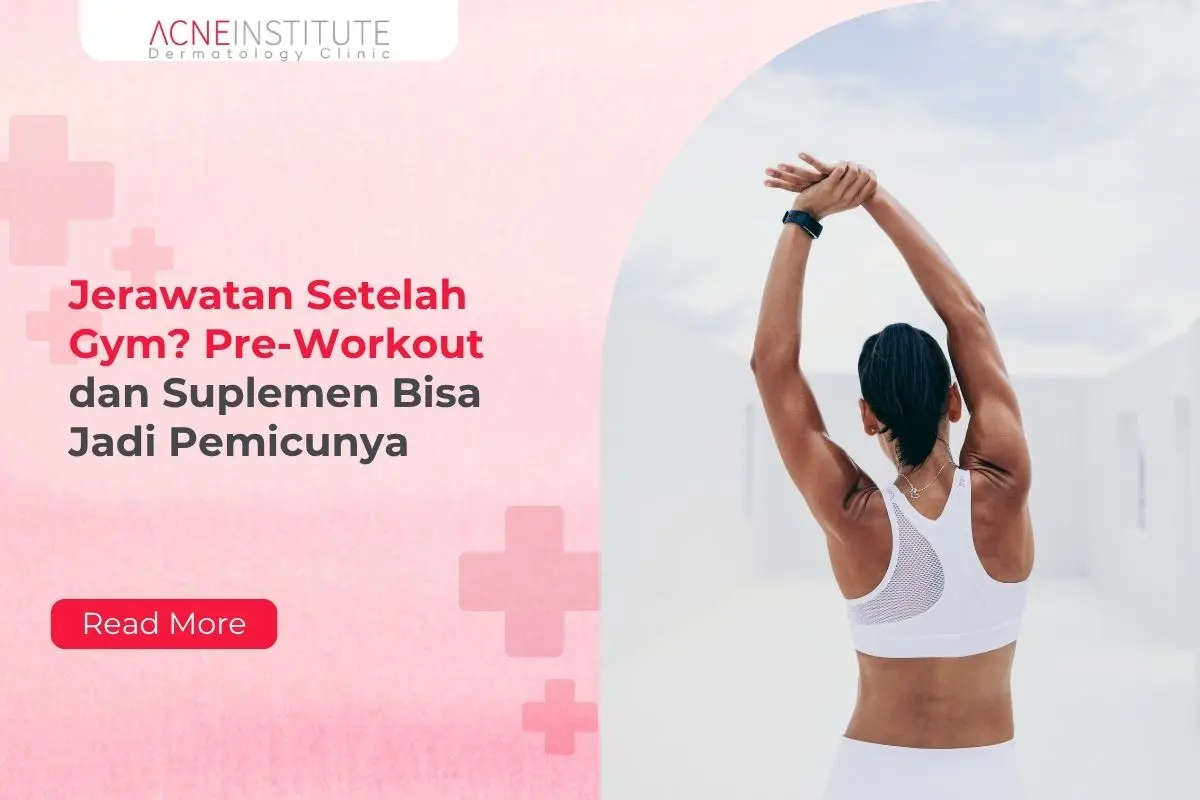 Jerawatan Setelah Gym? Pre-Workout dan Suplemen Bisa Jadi Pemicunya