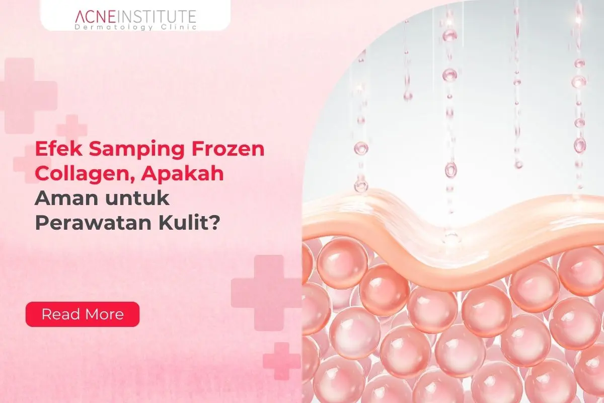 Efek Samping Frozen Collagen, Apakah Aman untuk Perawatan Kulit?