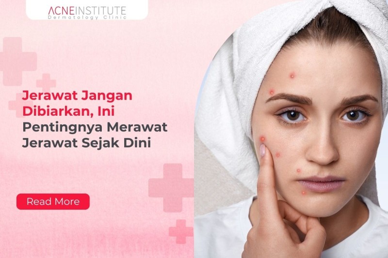 Jerawat Jangan Dibiarkan, Ini Pentingnya Merawat Jerawat Sejak Dini