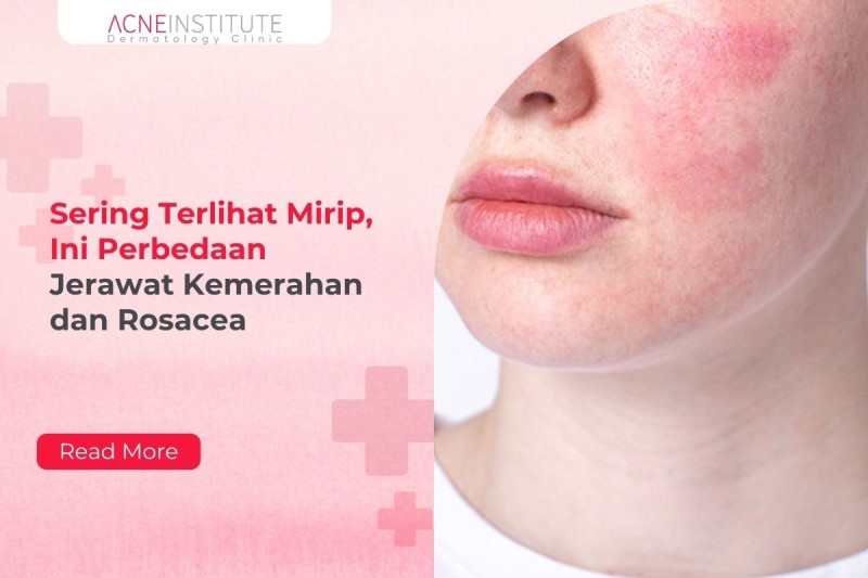 Sering Terlihat Mirip, Ini Perbedaan Jerawat Kemerahan dan Rosacea