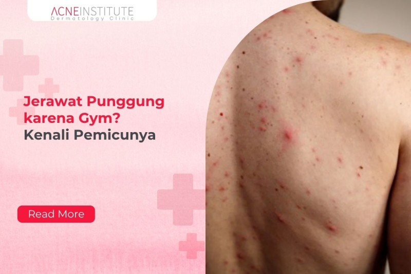 Jerawat Punggung karena Gym? Kenali Pemicunya
