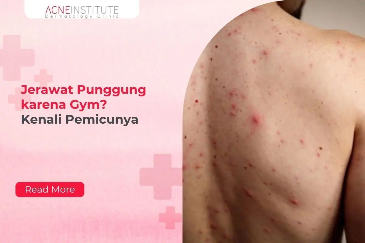 Jerawat Punggung karena Gym? Kenali Pemicunya