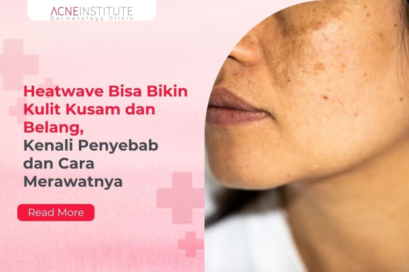 Heatwave Bisa Bikin Kulit Kusam dan Belang, Kenali Penyebab dan Cara Merawatnya