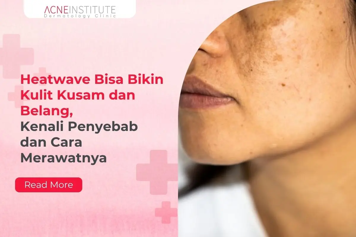 Heatwave Bisa Bikin Kulit Kusam dan Belang, Kenali Penyebab dan Cara Merawatnya