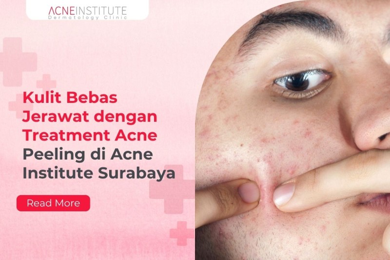 Kulit Bebas Jerawat dengan Treatment Acne Peeling di Acne Institute Surabaya