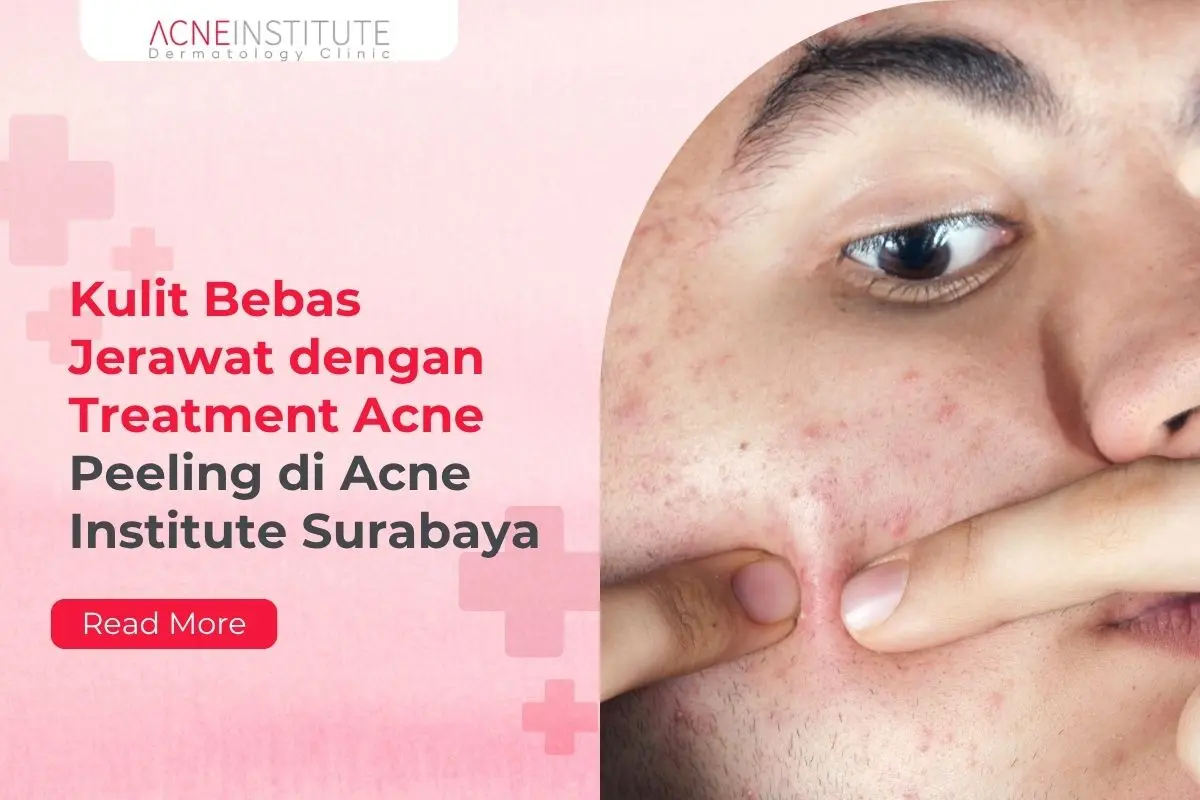 Kulit Bebas Jerawat dengan Treatment Acne Peeling di Acne Institute Surabaya