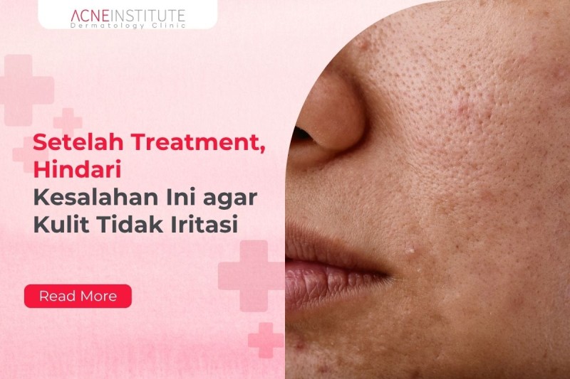 Setelah Treatment, Hindari Kesalahan Ini agar Kulit Tidak Iritasi