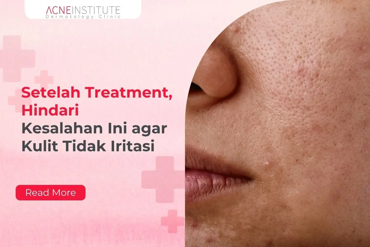 Setelah Treatment, Hindari Kesalahan Ini agar Kulit Tidak Iritasi
