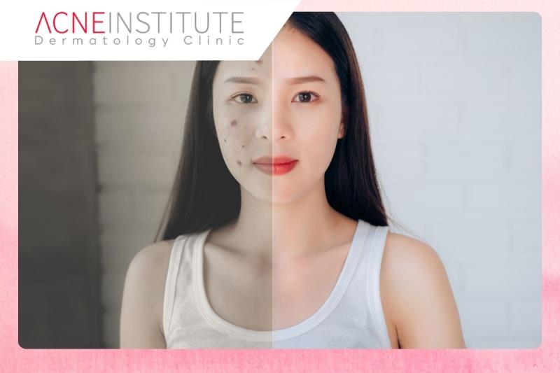 Mengapa Makeup Bisa Memperburuk Jerawat? Mengapa Makeup Bisa Memperburuk Jerawat?