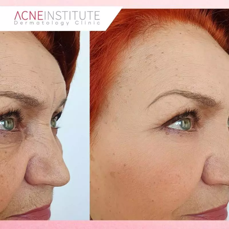 Hasil Botox Sebelum dan Sesudah Treatment