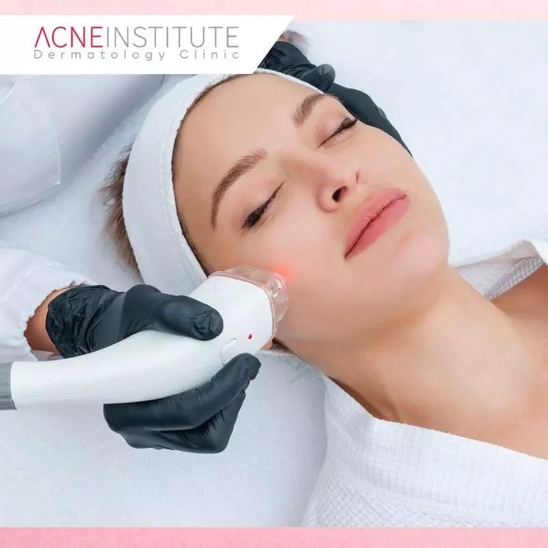 Treatment Khusus untuk Mengatasi Jerawat Membandel di Acne Institute Jakarta