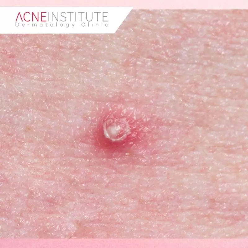 Kapan Harus Melakukan Treatment Khusus untuk Jerawat Membandel?