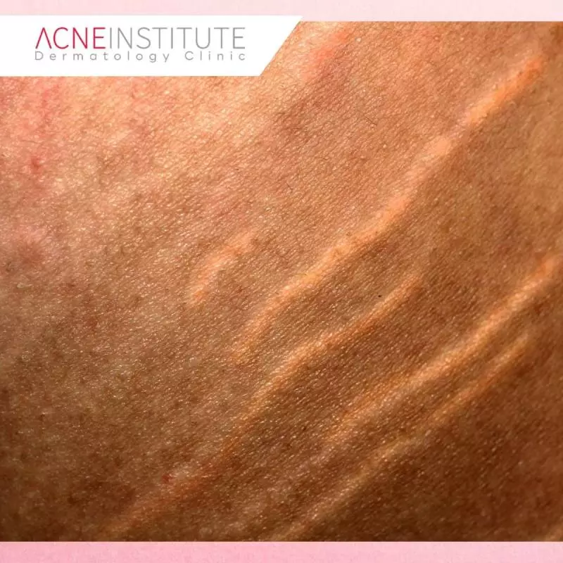 Tips Maksimalkan Hasil Treatment Stretch Mark