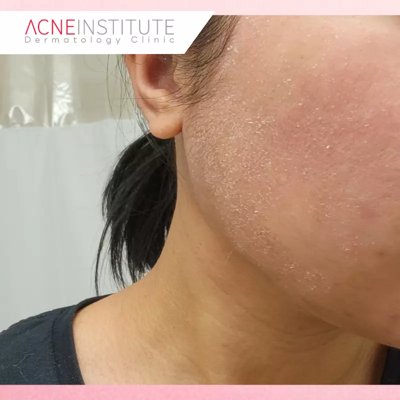 Gejala Retinoid Dermatitis yang Perlu Diwaspadai