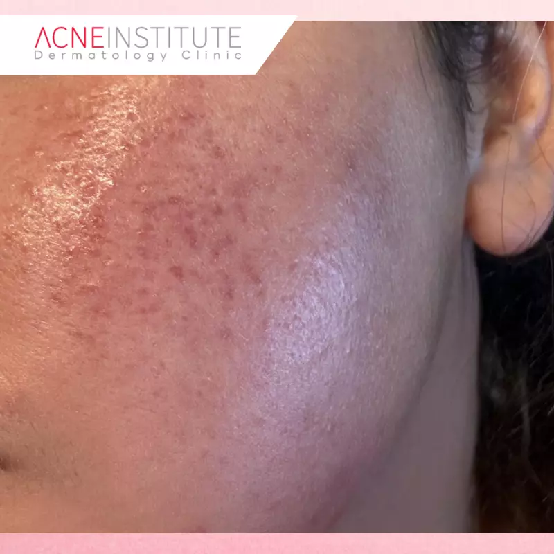 Dermatitis Kontak Akibat Skincare