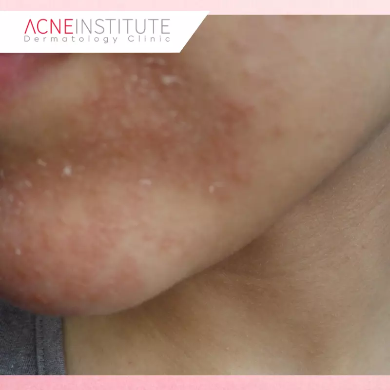 Gejala Seborrheic Dermatitis yang Perlu Diwaspadai