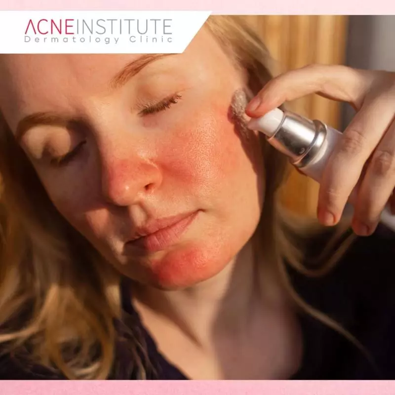 Apa Itu Rosacea dan Gejala yang Sering Muncul?