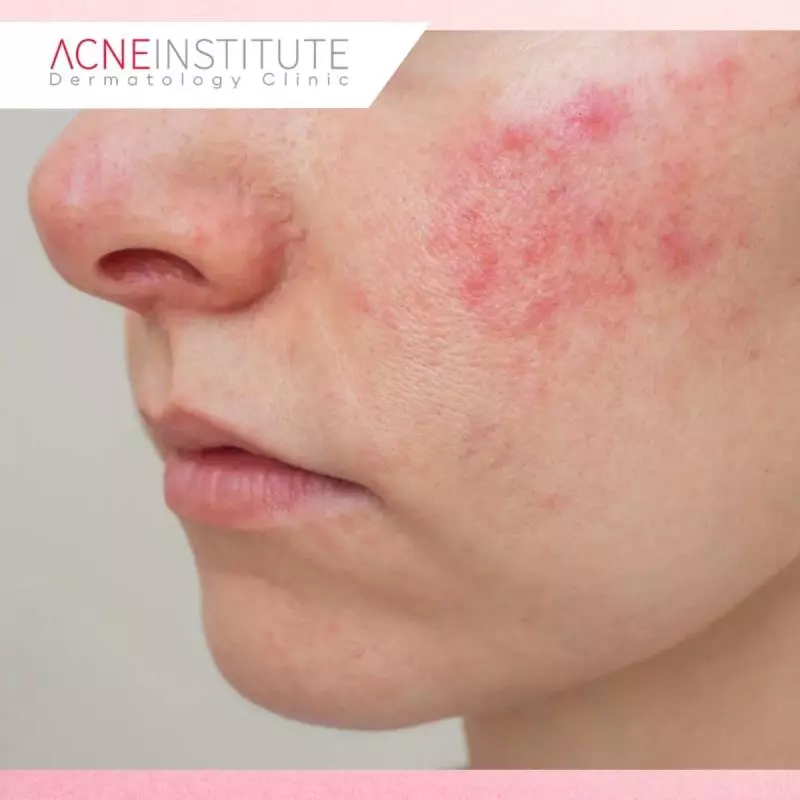 Faktor di Iklim Tropis yang Memicu Flare-Up Rosacea
