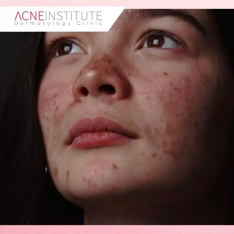 Tanda Kulit Kamu Mungkin Mengalami Rosacea, Bukan Jerawat