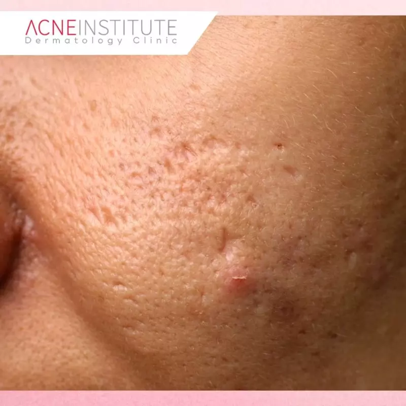 Pilihan Treatment Berdasarkan Jenis Bekas Jerawat