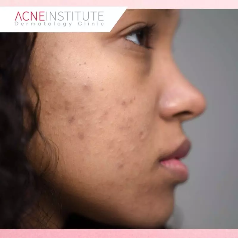 Bekas Jerawat dan Keloid, Mengapa Sulit Hilang dengan Perawatan Biasa?