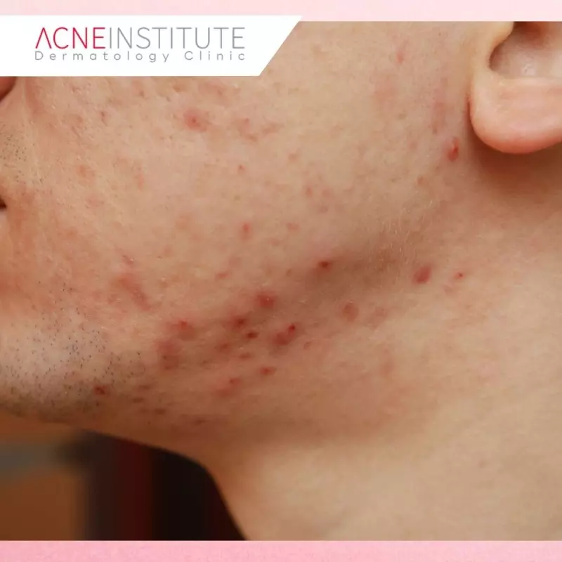 Mengapa Bekas Jerawat Merah dan Hitam Membutuhkan Treatment yang Berbeda?