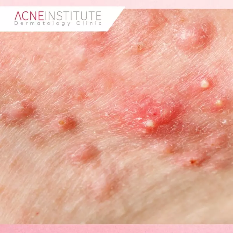 Gejala Acne Keloidalis Nuchae yang Perlu Diperhatikan