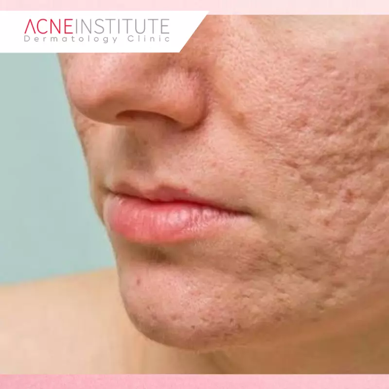 Keunggulan Modern Acne Scar Treatment