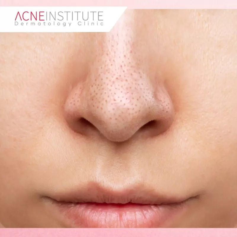 Tips Mencegah Jerawat di Hidung Muncul Kembali