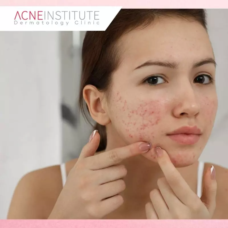 Berapa Lama Hasil Treatment Bekas Jerawat Terlihat?