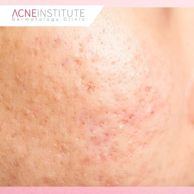 Treatment untuk Rolling Scar yang Membuat Kulit Bergelombang
