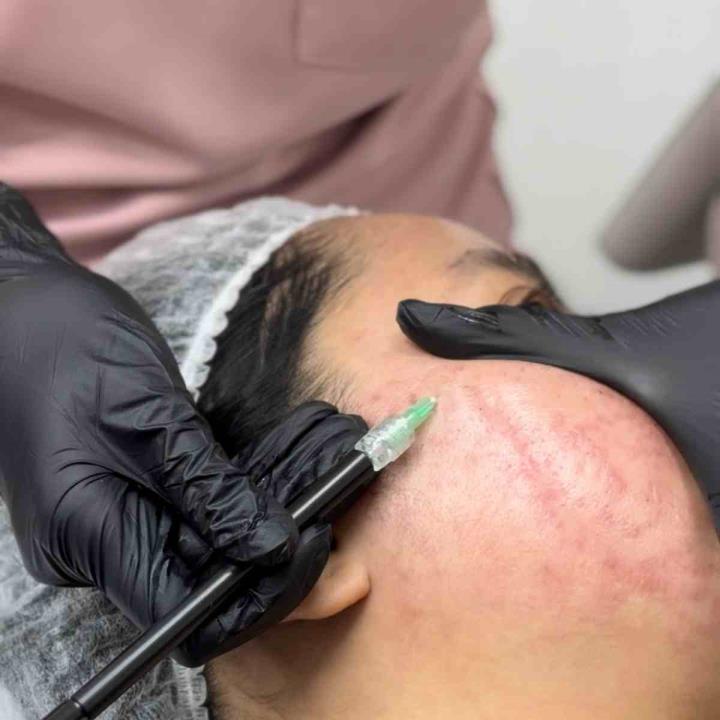 acne scar surgery 16035257189
