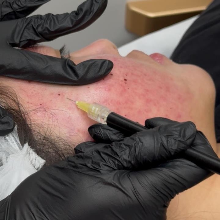 co2 subcision scarfill 16031245537