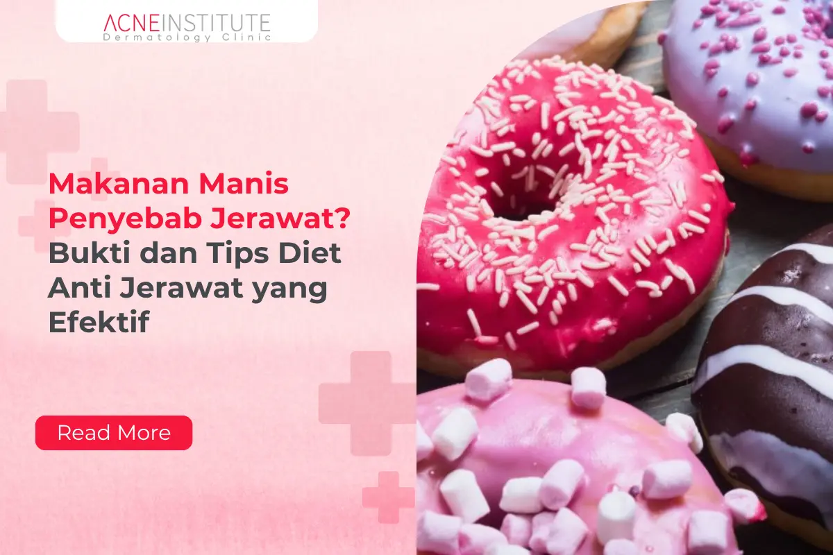 Makanan Manis Penyebab Jerawat? Bukti dan Tips Diet Anti Jerawat yang Efektif