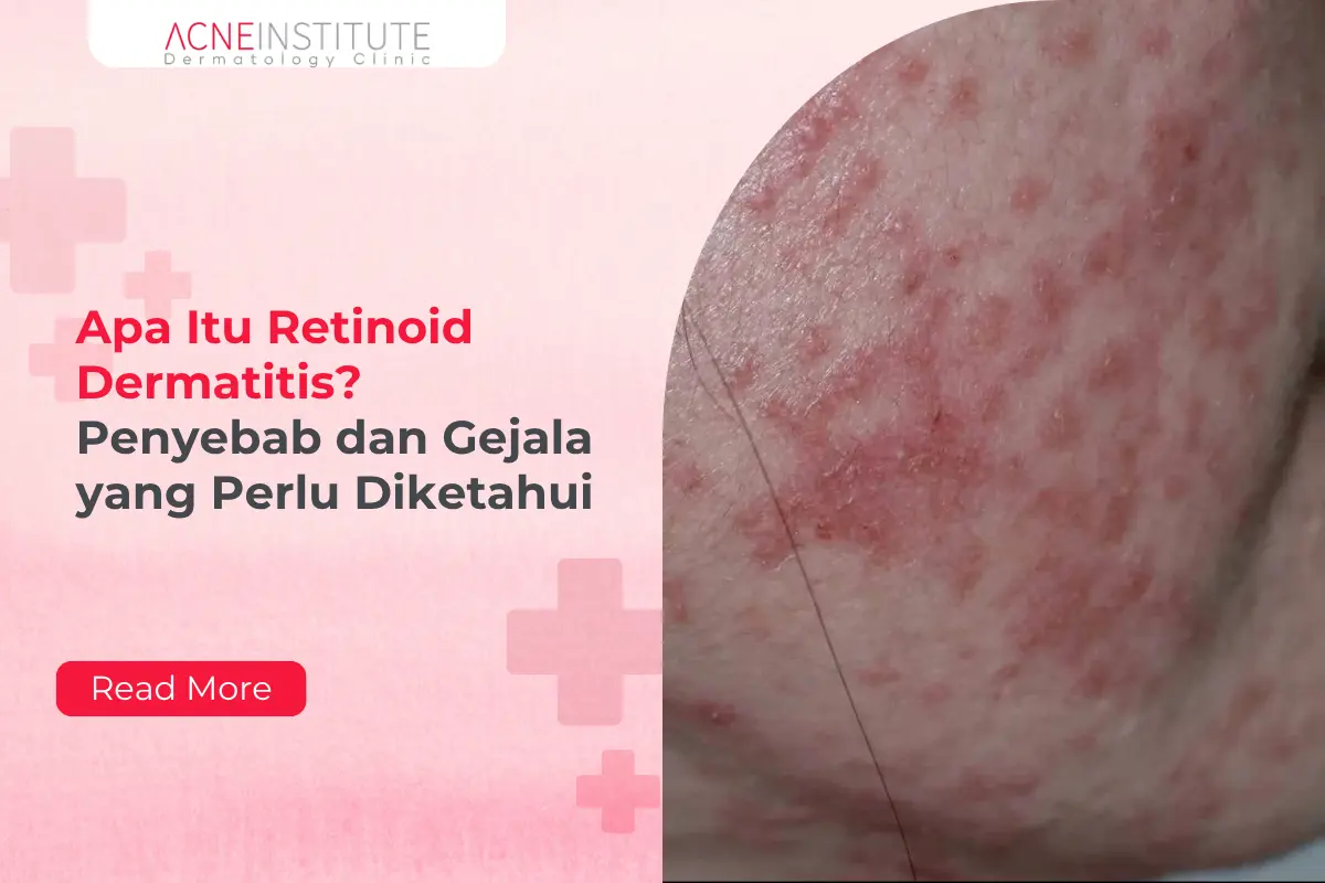Apa Itu Retinoid Dermatitis? Penyebab dan Gejala yang Perlu Diketahui
