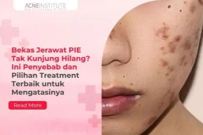 Bekas Jerawat PIE Tak Kunjung Hilang? Ini Penyebab dan Pilihan Treatment Terbaik untuk Mengatasinya