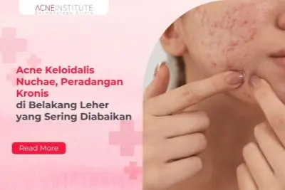 Acne Keloidalis Nuchae, Peradangan Kronis di Belakang Leher yang Sering Diabaikan