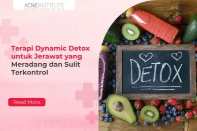 Terapi Dynamic Detox untuk Jerawat yang Meradang dan Sulit Terkontrol