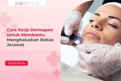 Cara Kerja Dermapen untuk Membantu Menghaluskan Bekas Jerawat