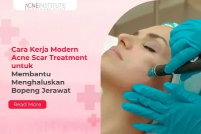 Cara Kerja Modern Acne Scar Treatment untuk Membantu Menghaluskan Bopeng Jerawat