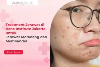 Treatment Jerawat di Acne Institute Jakarta untuk Jerawat Meradang dan Membandel