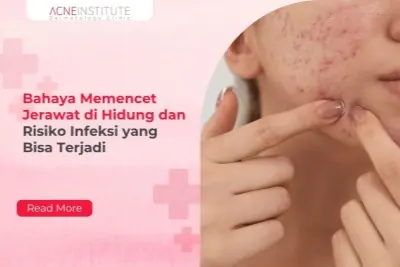 Bahaya Memencet Jerawat di Hidung dan Risiko Infeksi yang Bisa Terjadi