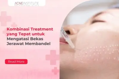 Kombinasi Treatment yang Tepat untuk Mengatasi Bekas Jerawat Membandel