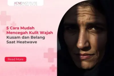 5 Cara Mudah Mencegah Kulit Wajah Kusam dan Belang Saat Heatwave