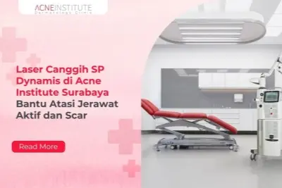 Laser Canggih SP Dynamis di Acne Institute Surabaya Bantu Atasi Jerawat Aktif dan Scar