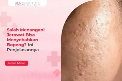 Salah Menangani Jerawat Bisa Menyebabkan Bopeng? Ini Penjelasannya