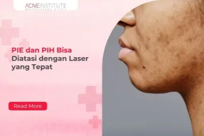 PIE dan PIH Bisa Diatasi dengan Laser yang Tepat